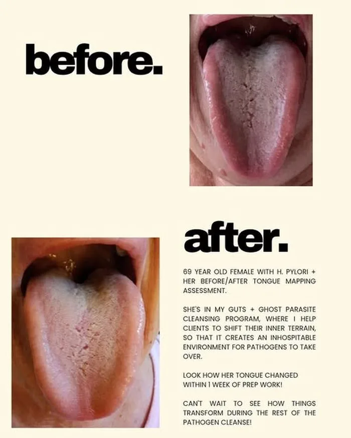 69-year-old 1:1 client's before and after tongue mapping assessment, showing her tongue changing within one week of prep work, ahead of H. pylori-targeted protocol