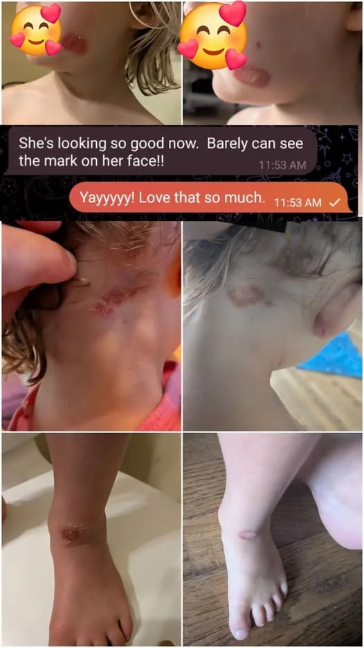 Text thread and progress photos showing the skin condition clearing over several days