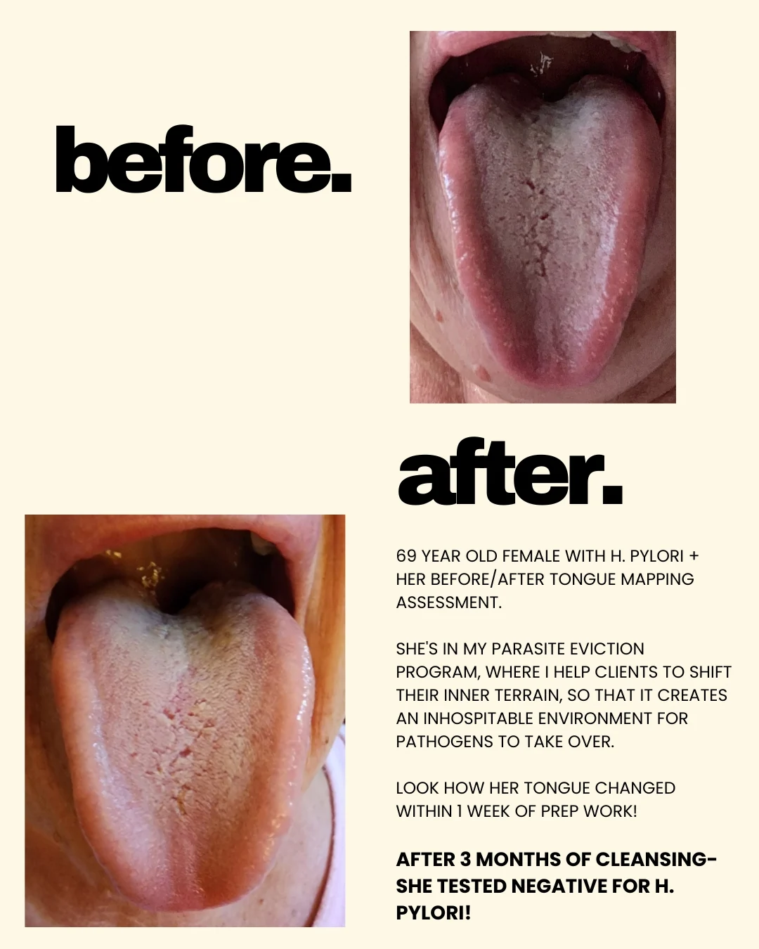 Before and after tongue mapping photos of a 69-year-old client who tested positive for H. pylori. The before photo shows a thick white coating across the whole tongue; the after photo, one week into prep work, shows the coating much thinner and the tongue a healthier pink. She tested negative for H. pylori after three months of cleansing.