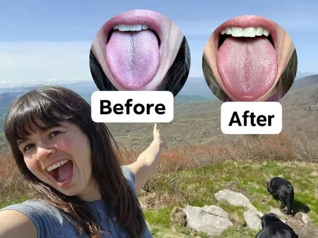 Real Guts + Ghosts client's before and after tongue photos, showing her tongue coating already clearing during the prep phase