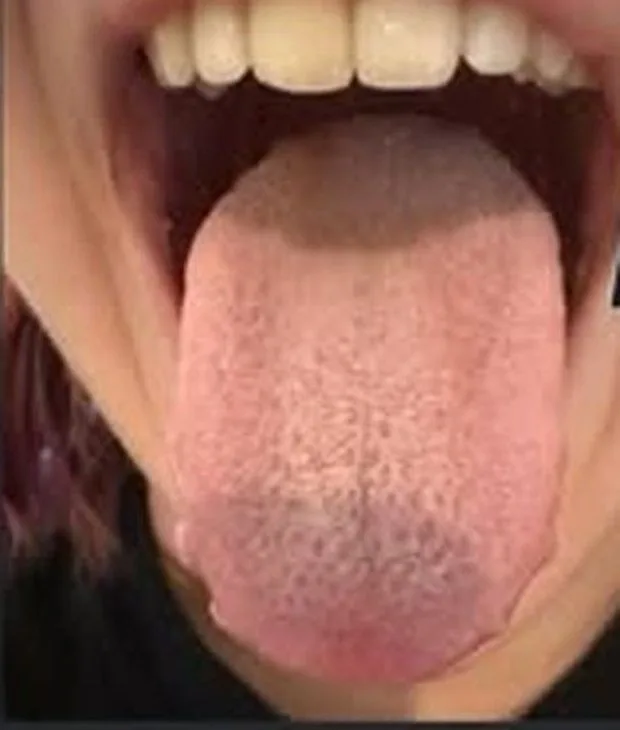 The same child's tongue two days later: coating almost entirely gone, healthy pink surface.