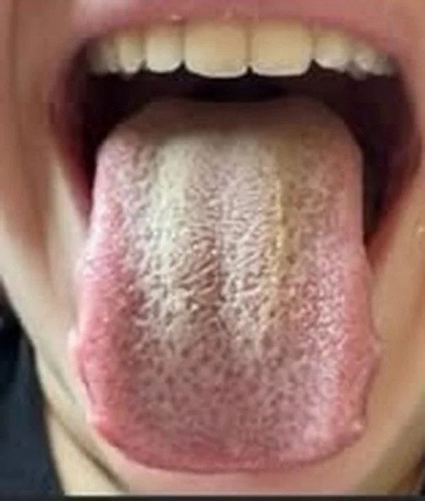 A child's tongue before: a thick white-yellow coating across the whole surface.