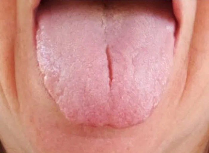 The same adult tongue weeks later: thinner coating, better color, less swelling.