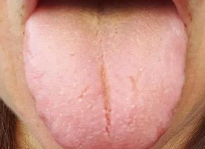 An adult tongue before: pale heavy coating, swollen body, central crack.